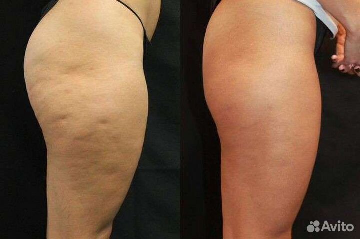 Вакуумный массаж, кавитация, RF