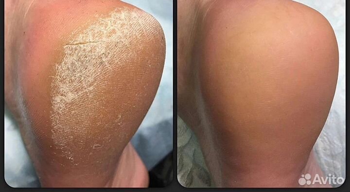 Педикюр аппарат