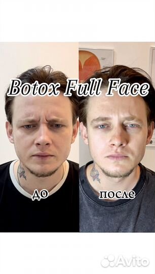 Ботокс Full Face