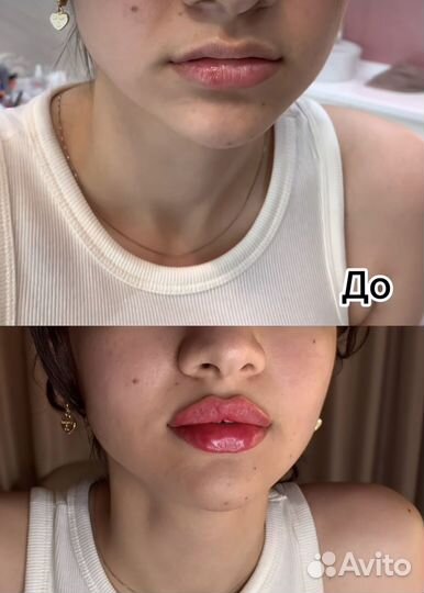 Увеличение губ Full Face Липолитик Углы