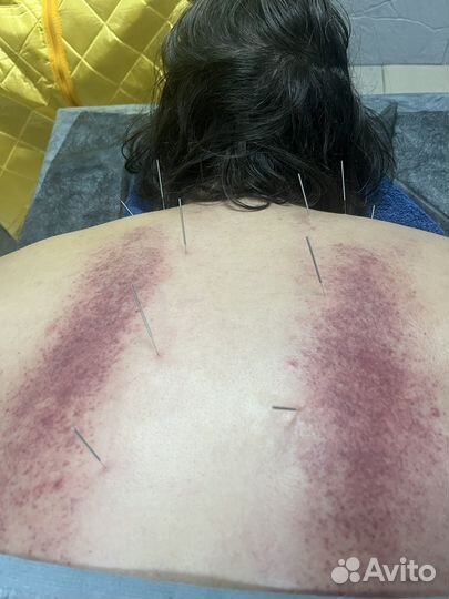 Антицеллюлитный массаж