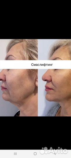 СМАС лифтинг лица