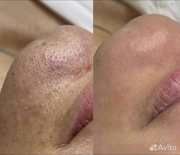 Чистка лица, пилинги, биоревитализация