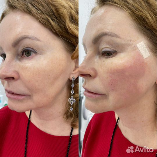 Биоревитализация