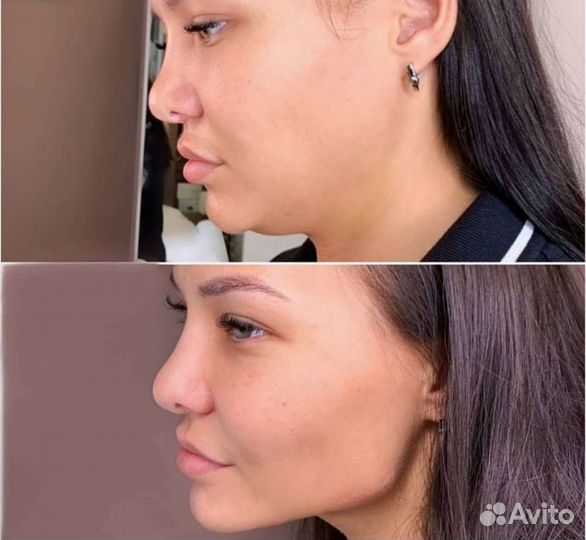 Иньекционная косметология