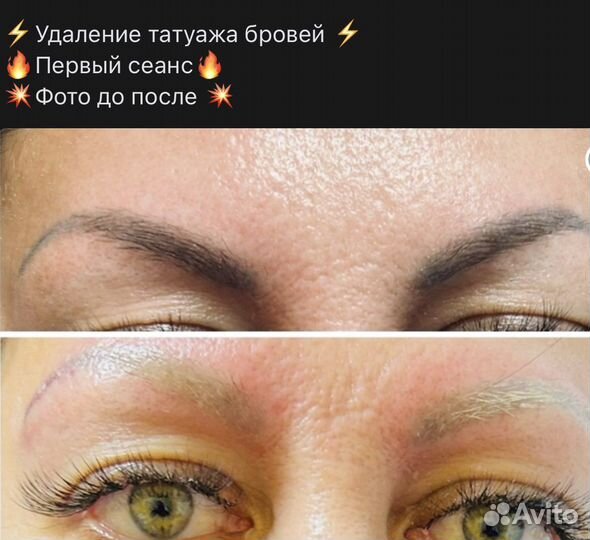 Лазерное удаление тату, татуажа