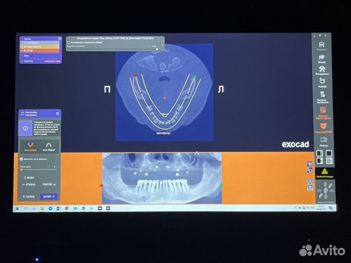 Программа exocad с установкой