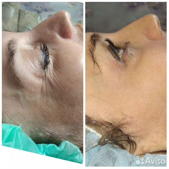 Вакуумный массаж, Кавитация, Rf лифтинг