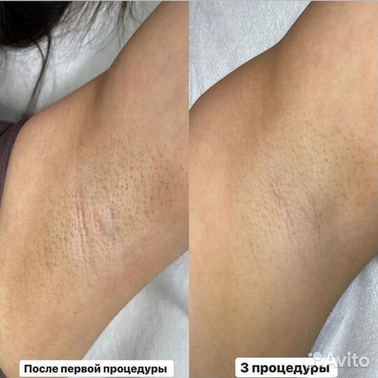 Лазерная эпиляция: глубокое бикини