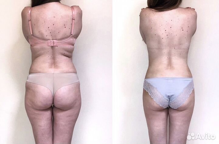 Антицеллюлитный аппаратный массаж