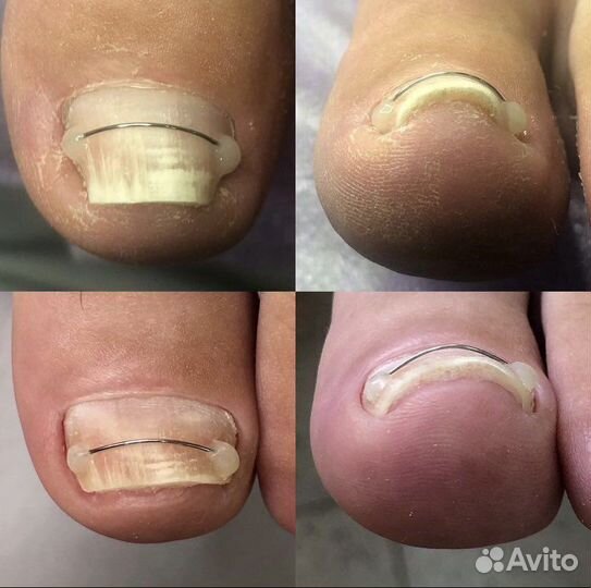 Подолог, коррекция вросших ногтей, педикюр