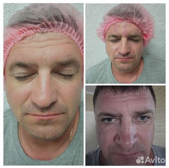 Плазмолифтинг