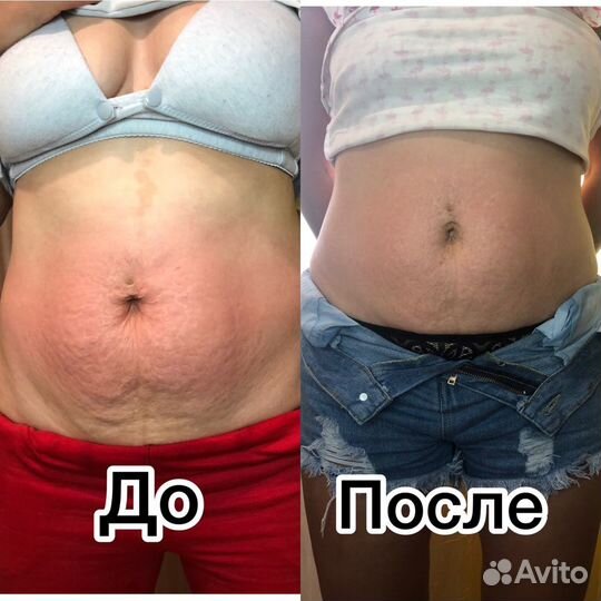 Антицеллюлитный массаж