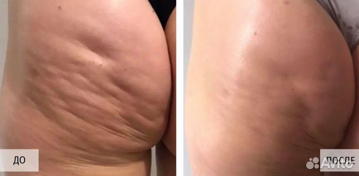 Массаж коррекция фигуры