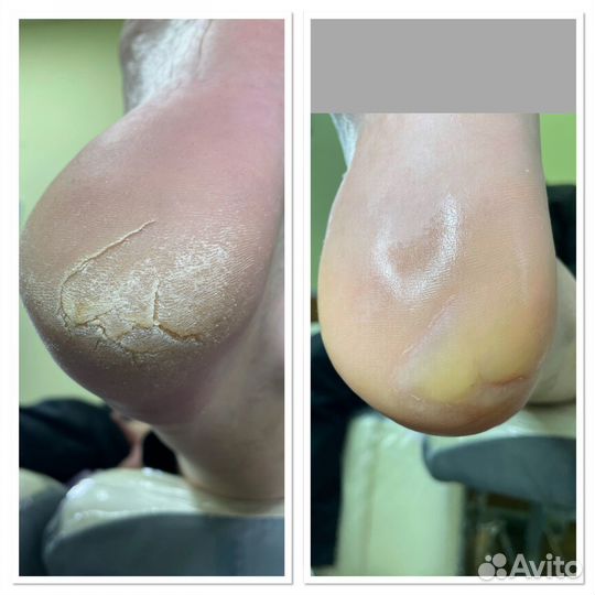 Лечебный педикюр