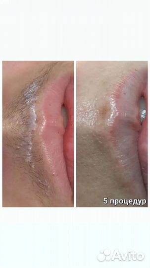 Электроэпиляция Краснодар / Apilus