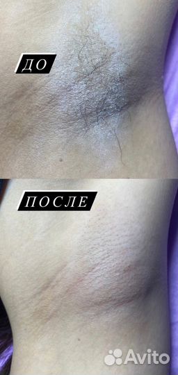Восковая депиляция