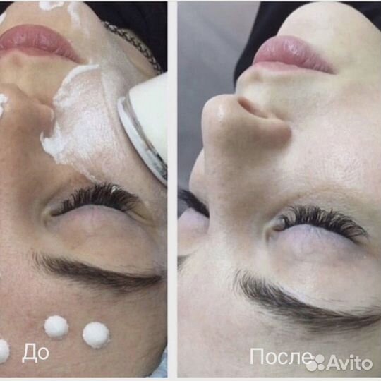 Чистка лица, пилинги