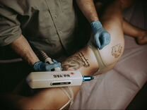Лазерное удаление татуировок Карбоновый пилинг