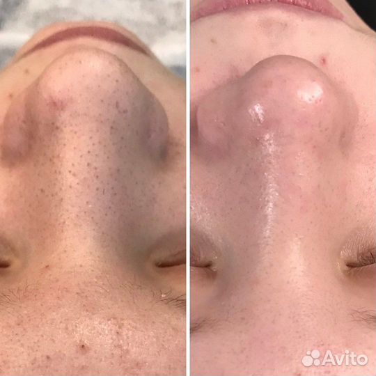 Комбинированная чистка лица