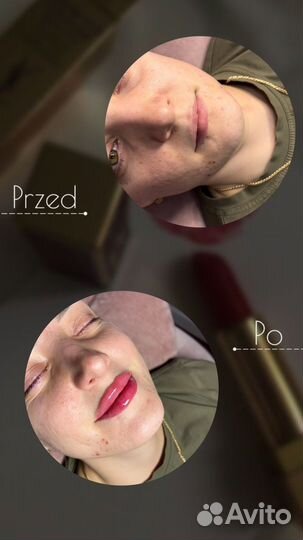 Увеличение губ / Выведение губ