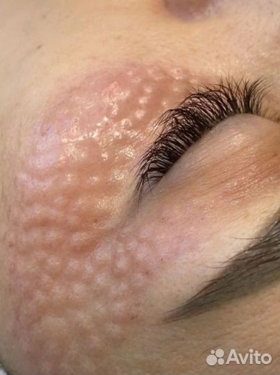 Лазерная эпиляция пилинг чистка лица косметолог