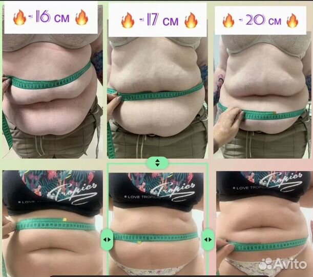 Плоский живот - размер за 1 процедуру В Тольятти