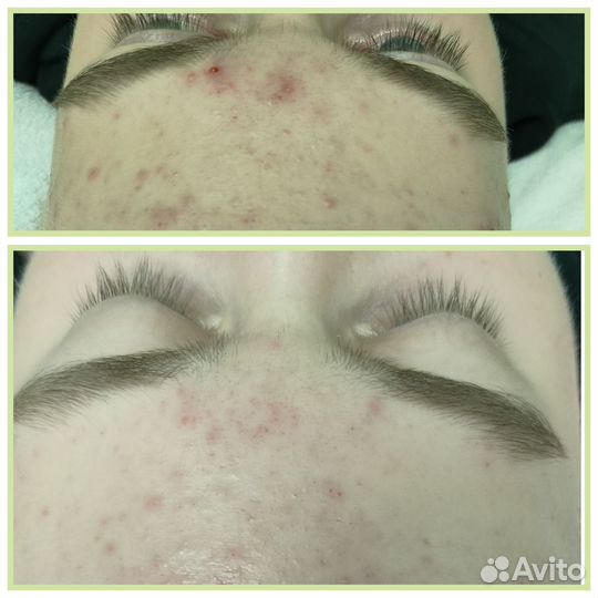 Холодная плазма омоложение