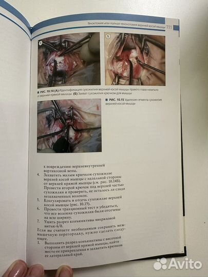 Хирургия косоглазия