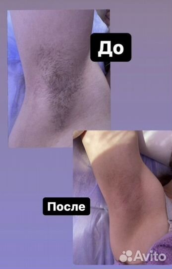 Депиляция