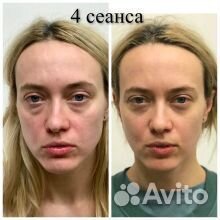 Массаж лица