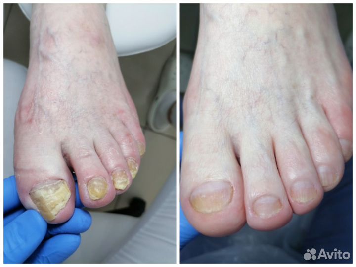 Сертифицированный подолог, лечебный педикюр