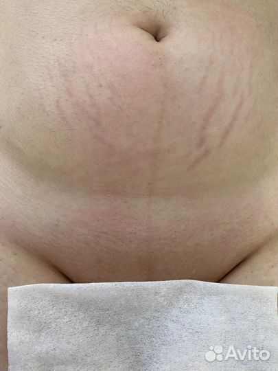 SPA-Шугаринг