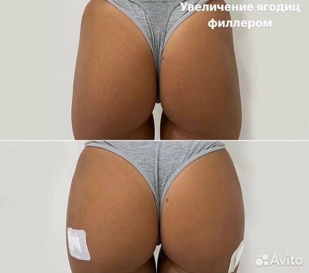 Увеличение ягодиц