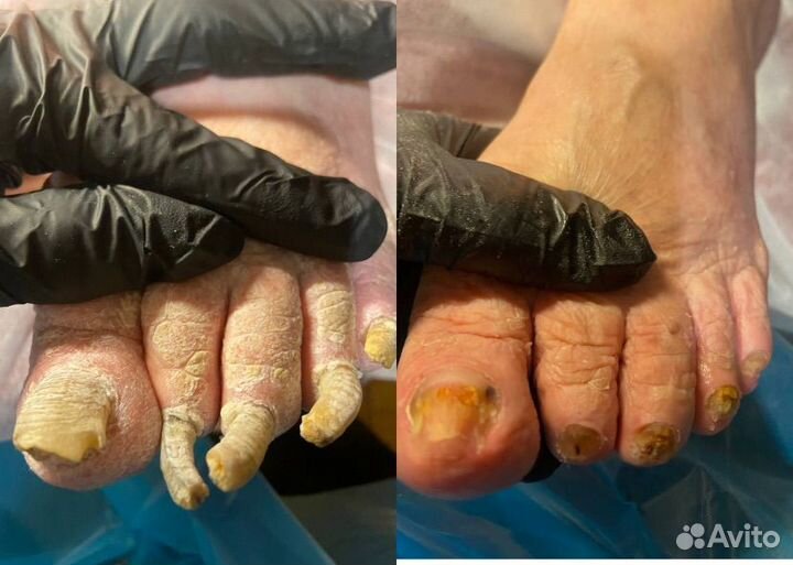 Подолог Медицинский педикюр Выезд на дом