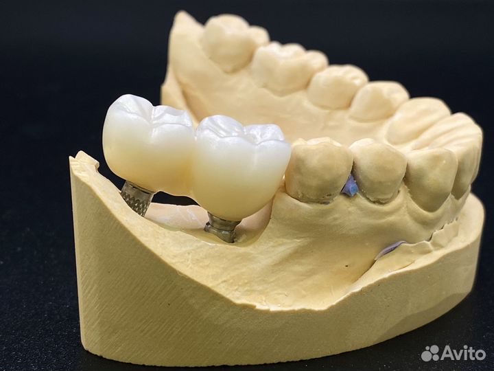 Изготовление анатомической коронки из 3D диоксид ц