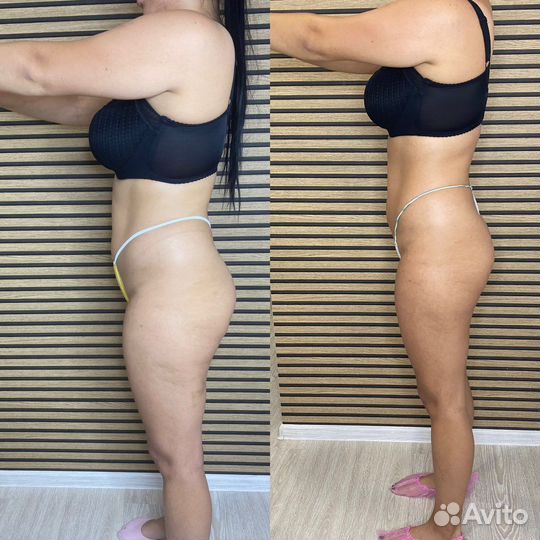 Аппаратная коррекция фигуры и лица