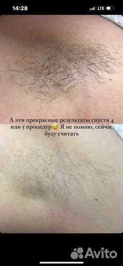 Электроэпиляция