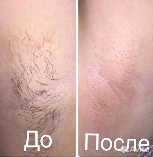 Шугаринг