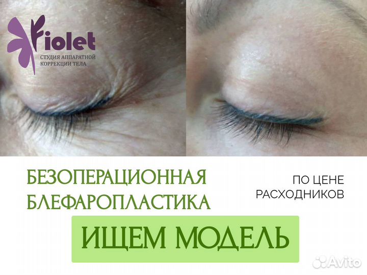 Дарсонвализация