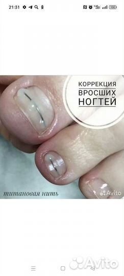 Вросший Ногть, установка титановой нити