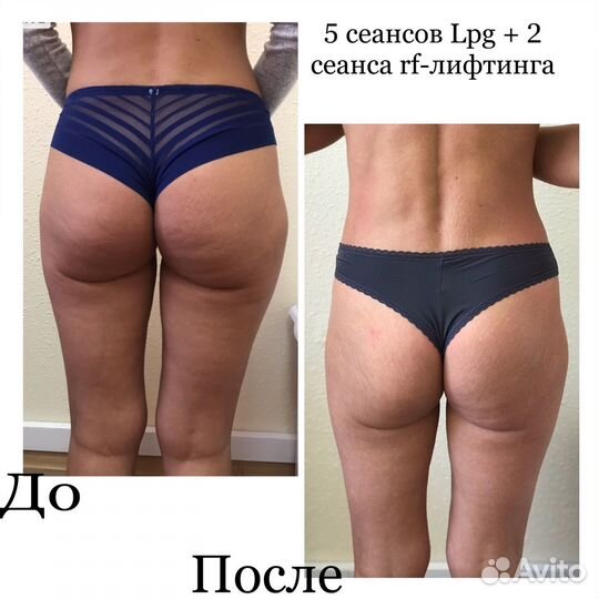 LPG массаж, кавитация,криолиполиз