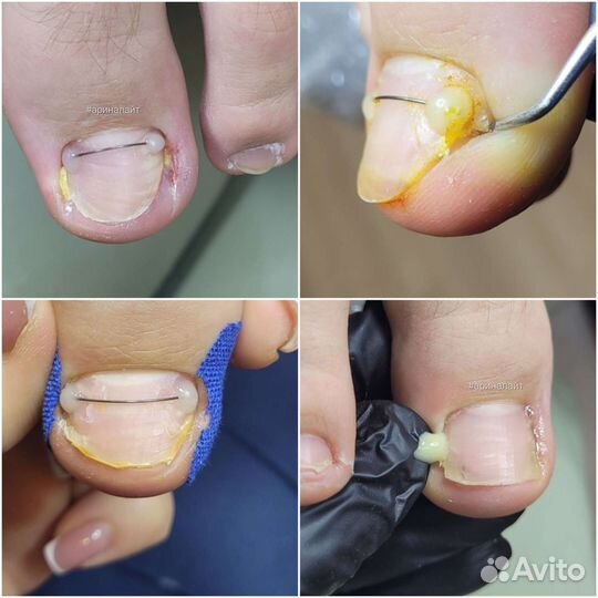 Сложный педикюр трещины вросший ноготь ищу модель