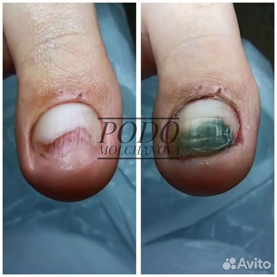 Подолог. Работа с проблемами стопы. Вросший ноготь