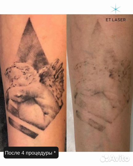 Лазерное удаление татуировок
