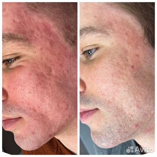 Лазерная шлифовка