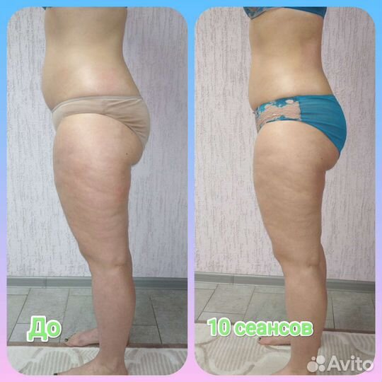 Антицеллюлитный массаж