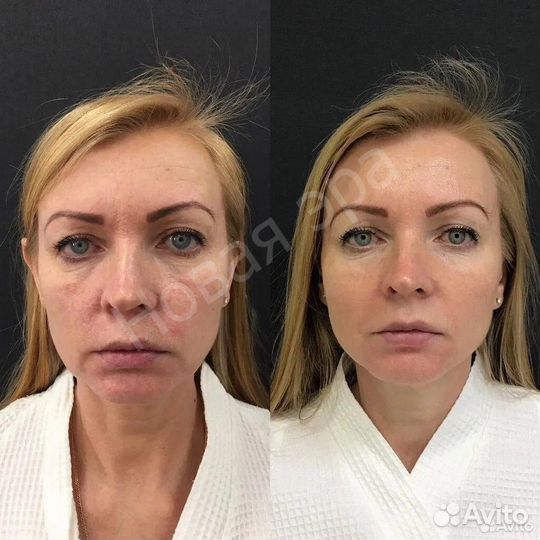 Игольчатый РФ лифтинг. Morpheus 8