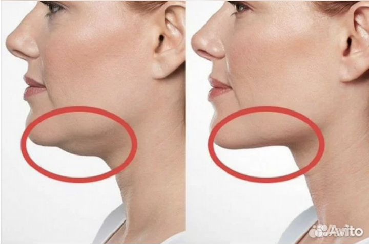 Криолиполиз