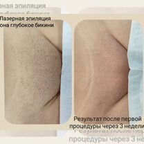 Лазерная эпиляция/Шугаринг/Восковая депиляция, Энгельс